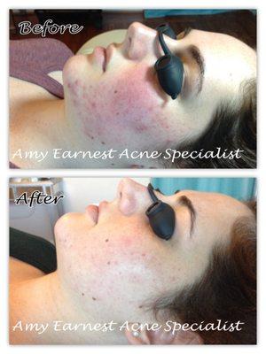 Amy Earnest Acne Specialist