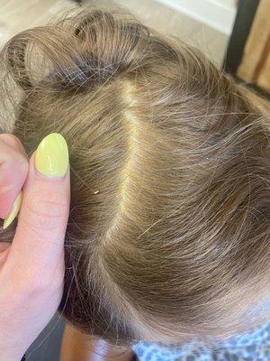 My daughters scalp prior to the treatment..