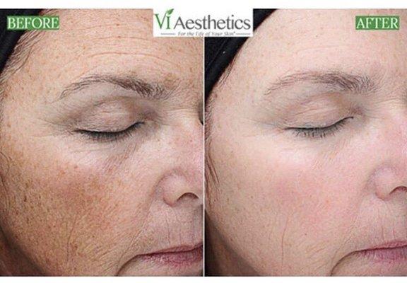 Who's ready for a good medical grade skin peel?