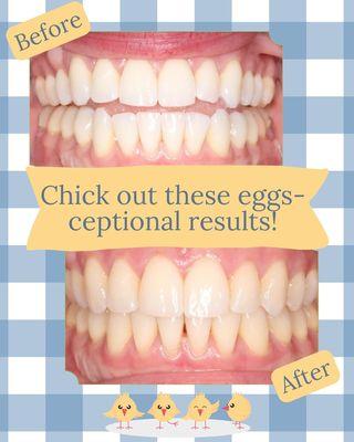Spring into a fresh smile with this egg-straordinary orthodontic transformation!