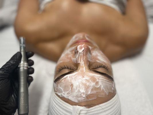 Pre numbing for this amazing microneedling treatment. Microneedling targets old scarring, anti aging, wrinkles, dark spots & max collagen!