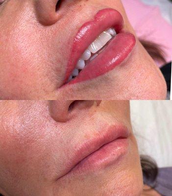 Before and After Lip Blush