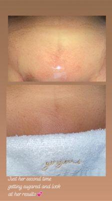 Brazilian done with a hydro jelly mask