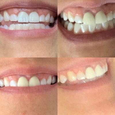 Before, during, and after crown replacement and teeth whitening. The top left is the new smile Dr. Ghorab gave me.