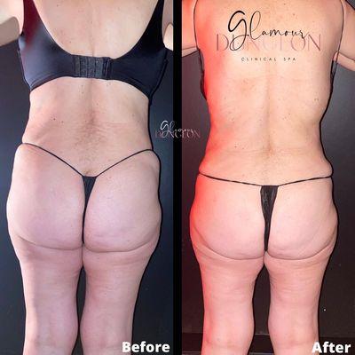 Skin tightening, non-invasive body sculpting, 1 treatment