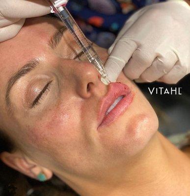 Lip filler restores volume and defines the structure of the lips.