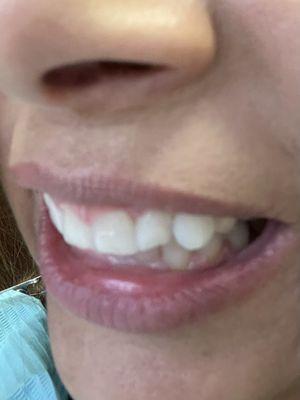 After 2 years of Invisalign and traditional braces.