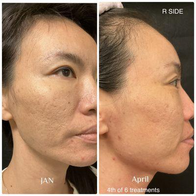 Laser Skin Treatment Before And After