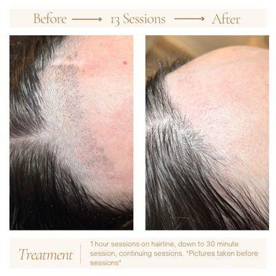 Beach Peach Electrolysis