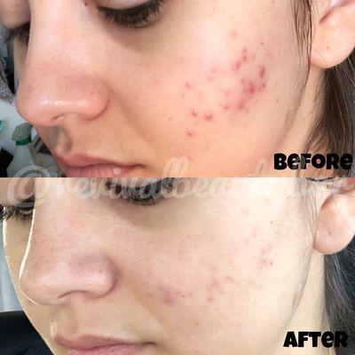 With consistency and patience, the Healing Acne Facial is completely life changing!