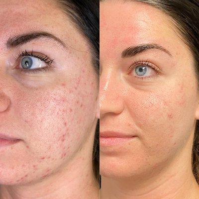 Before and 7 weeks after starting Acne Bootcamp