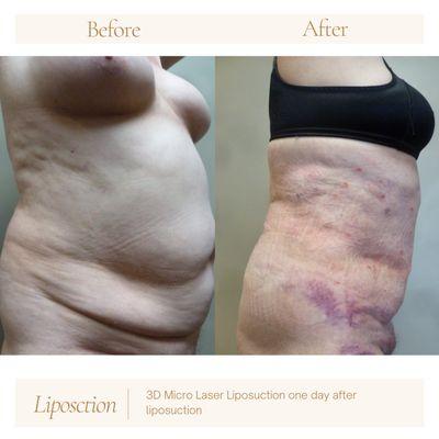 Jenesis Lipoplasty & Laser