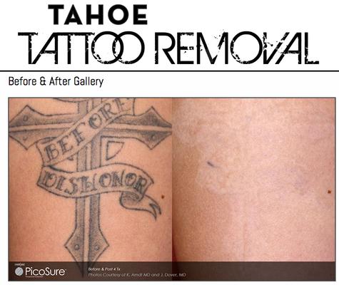 Tahoe Tattoo Removal