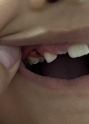 It was a baby molar.