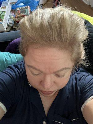 Six months later after treatment from caring staff at HPI Hair. Highly recommend the laser cap and scalp oil; Vitamin D, B-12, zinc