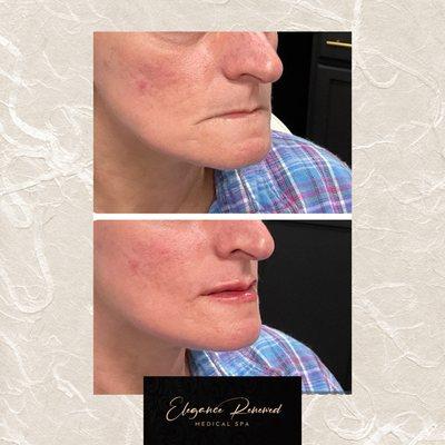 See the power an enhanced set of lips can have on your profile.