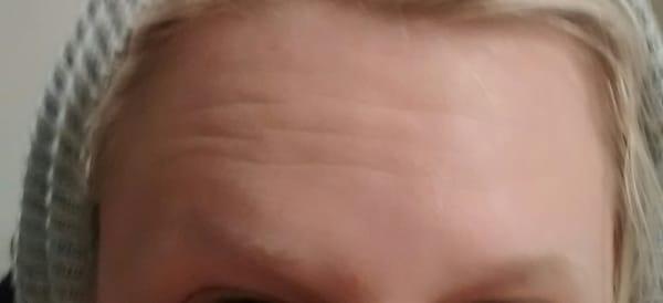 3 weeks after receiving 40 units of Xeomin in forehead. Not happy with the results.Botox and Dysaport worked much better for me.