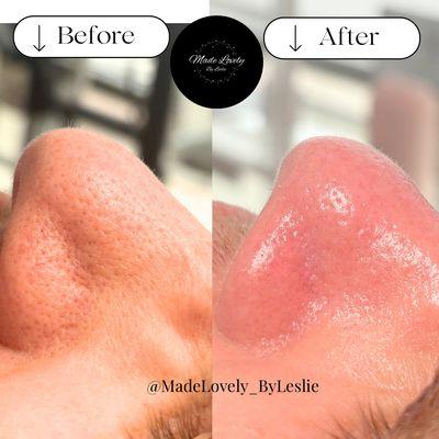 Cleansed pores after 1 Gentleman's Facial