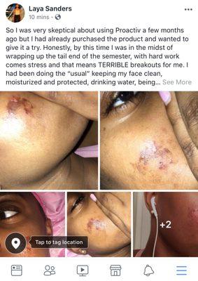 Please add me on Facebook and read and share this post about how Proactiv Skin Care RUINED my skin. Facebook name: Laya Sanders
