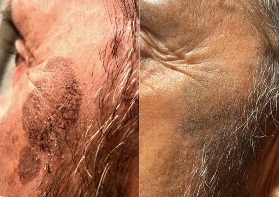 Sun spots don't just happen to women!!
This is after a single treatment!