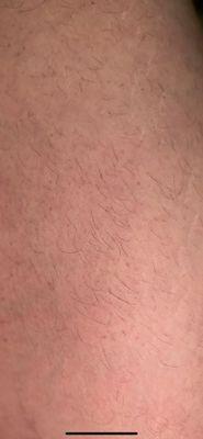 Renova Laser Hair Removal & MedSpa