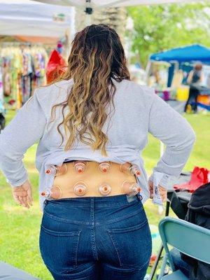 Cupping for the lower back will improve range of motion, lesson tension, & help get you instant pain relief :D