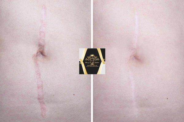 Scar Removal and Lightening