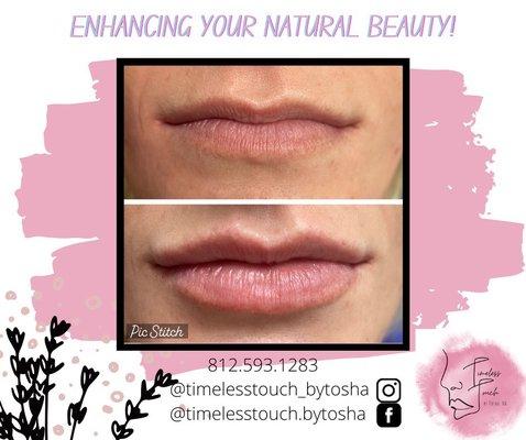 Lip enhancement