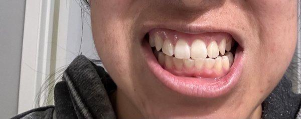 After 4 years of braces Looks bad do not recommend