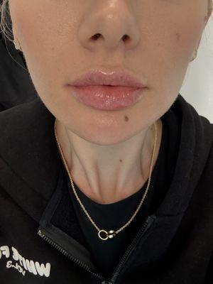 A week after lip filler