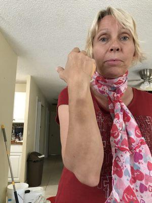 Bruises and a protruding bone from false arrest by Deputy Sheriff Jerry Sosa because of the Family Dollar manager.