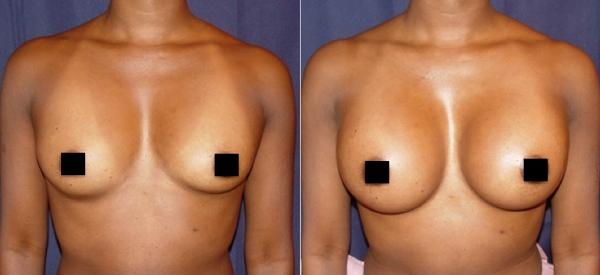 Silicone breast implants - 350ccs