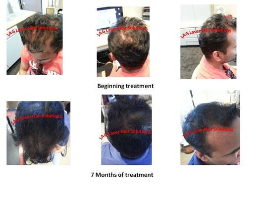 Male hair loss treatment after 7 months