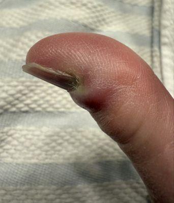 Swollen right thumb showing signs of infection.