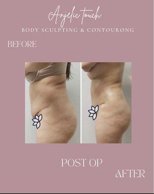 Post Op Manual Lymphatic Drainage After her first session