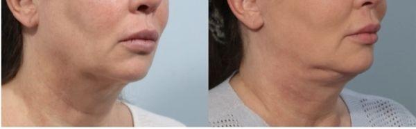 Lump from neck lift in right photo post op.