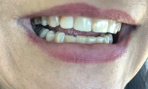 Dr. Mike fixed my chipped tooth! Yay!!