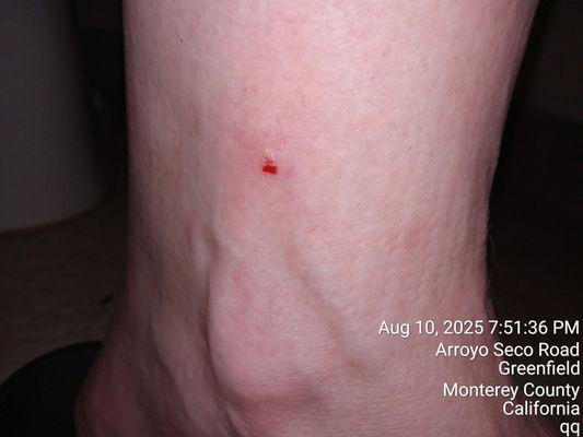 One of many bedbug bites