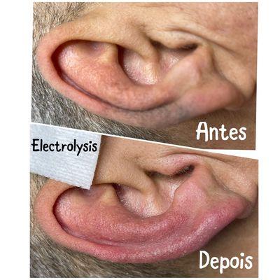 Electrolysis treatment