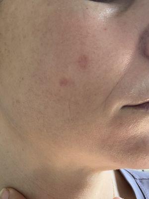 Scars left from spot removal.