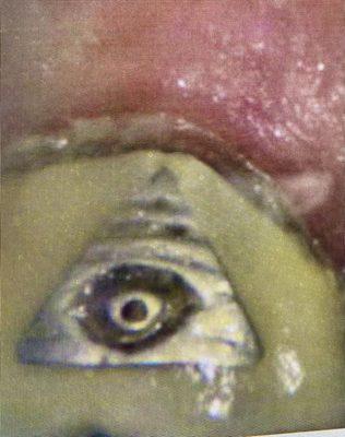 In 1980 Dr. Landers fabricated and installed this Artistic dental crown.