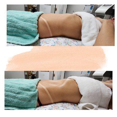 Brazilian lymphatic drainage massage. Helps with swelling, inflammation, water retention and Bloating