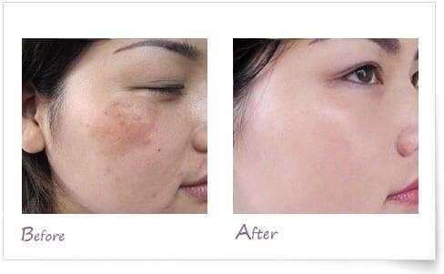 Before & After of Discoloration