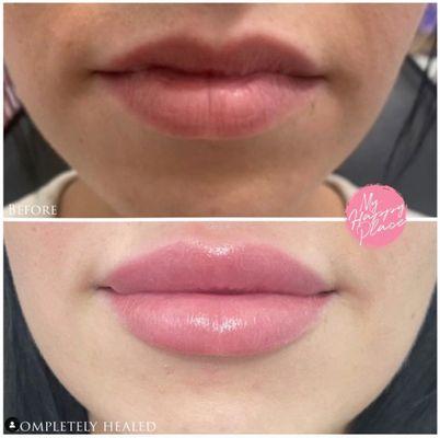 I'm O B S E S S E D with this transformation.
 This is the very first post I have ever done showing before fully H E A L E D lips.