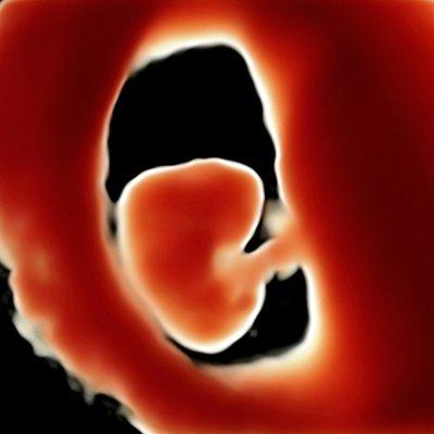 3D sonogram of 7 week fetus