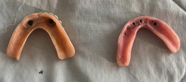 Original overdenture and one from Dr Sachdev.