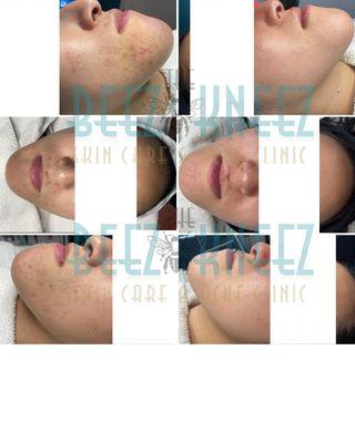 The Beez Kneez Skin Care and Acne Clinic