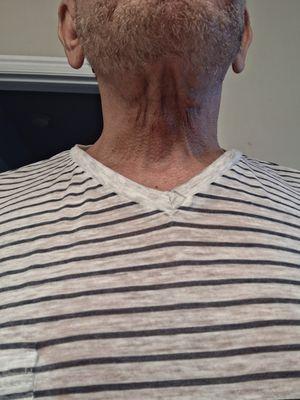 4 months post surgery.  Use your own judgment $7000. He made me worse.I have to go have revision by a real surgeon,  butcher