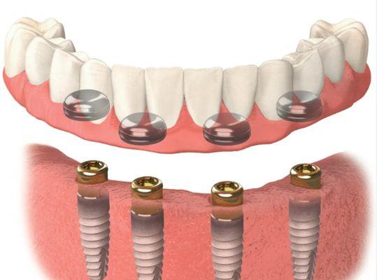 Access Dental Center-Implant Center