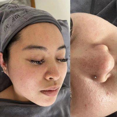 Before Essential facial